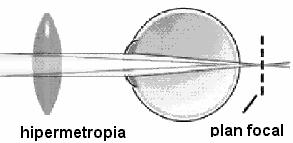 Noţiuni fundamentale de optică geometrică. Elemente de biofizica analizorului vizual În toate cazurile se corectează cu lentile divergente (Fig.