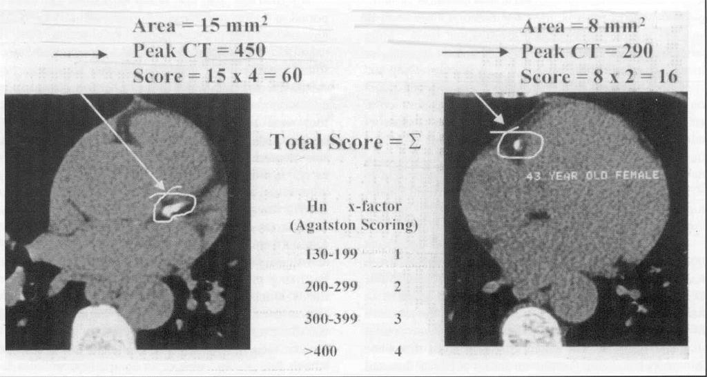 Agatston score Σε κάθε εγκάρσια τομή μετράται το Εμβαδόν (σε mm2) και η Πυκνότητα (σε HU) της ασβέστωσης προκύπτει μια τιμή