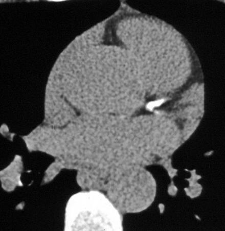 Calcium Volume Scoring Area = 15 mm 2 Peak CT =