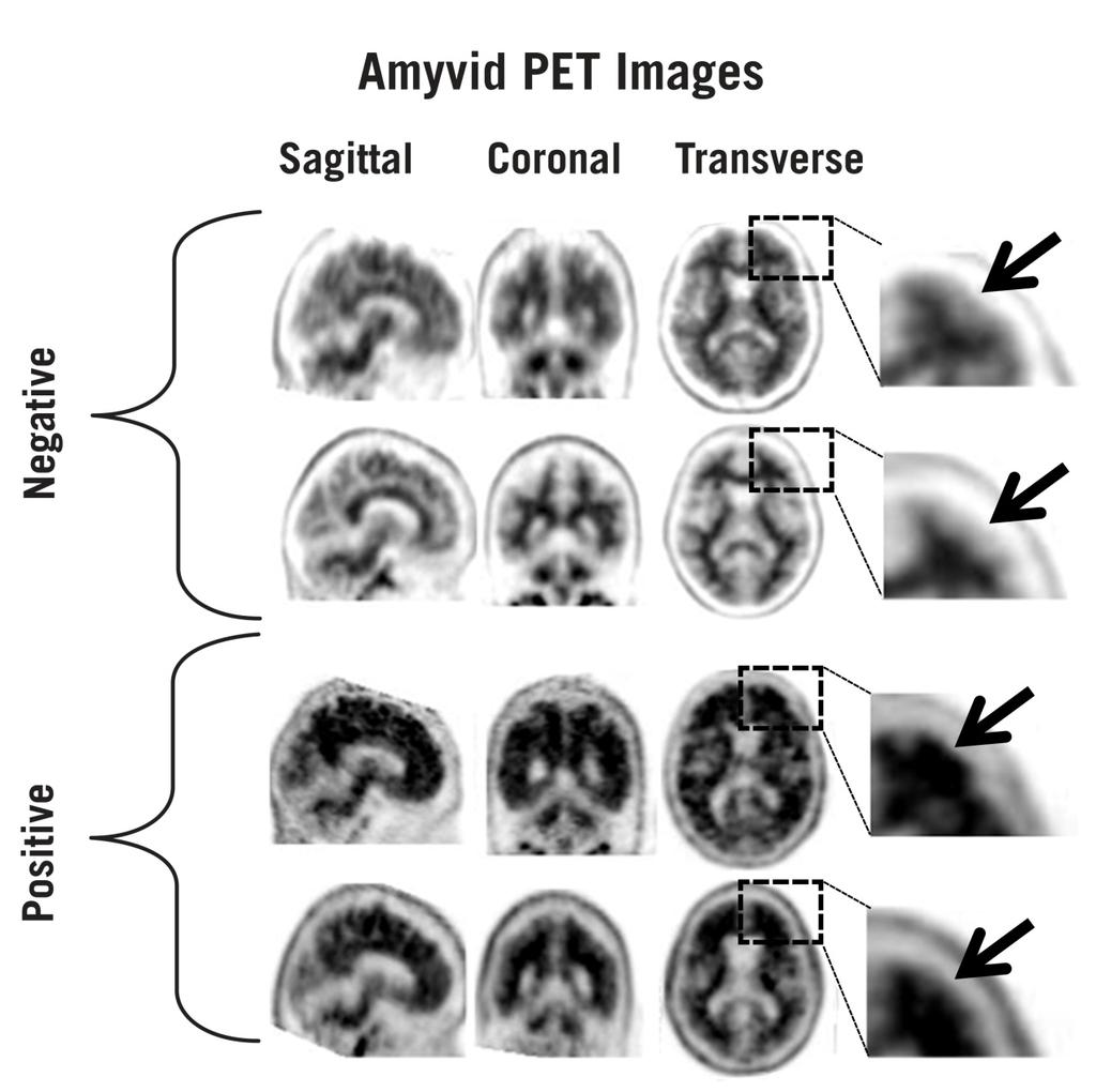 Εικόνα 1: Περιπτώσεις PET με τη χρήση Amyvid που παρέχουν παραδείγματα αρνητικών τομογραφιών (δύο πρώτες σειρές) και θετικών τομογραφιών (δύο τελευταίες σειρές).
