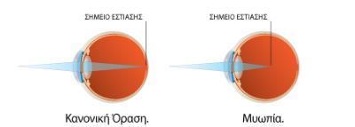 οφείλεται είτε σε μεγάλη διαθλαστική δύναμη (διαθλαστική μυωπία), είτε σε πολύ μεγάλο αξονικό μήκος του οφθαλμού (αξονική μυωπία), είτε και στα δύο.