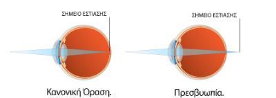 της προσαρμογής, η οποία δεν επιτρέπει στο άτομο να βλέπει πλέον καθαρά τα κοντινά αντικείμενα, ονομάζεται πρεσβυωπία.