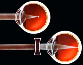 (Αλέξανδρος Δαμανάκις «Διάθλαση-Βασικές Αρχές και Τεχνική», Κών/νος Κάτσουλος, Γιώργος Ασημέλλης «Η Σύγχρονη Διαθλαστική Εξέταση», Γιώργος Ασημέλλης «Μαθήματα Οπτικής») Εικόνα 6: Διόρθωση μυωπικού