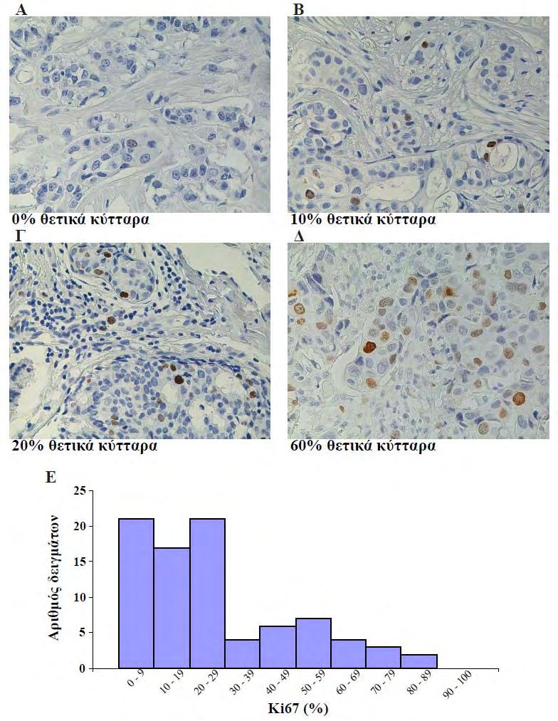 4. Αποτελέσματα Εικόνα 4.1.6: Ανοσοϊστοχημική έκφραση της πρωτεΐνης Ki67 σε δείγματα καρκίνου μαστού.