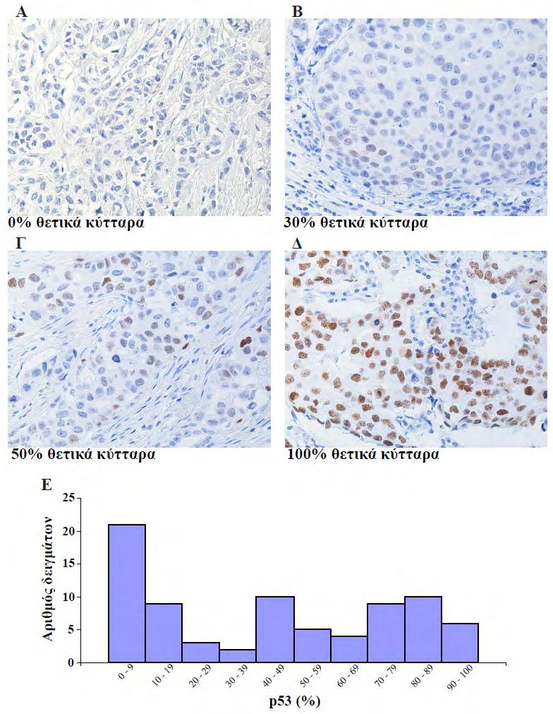 4. Αποτελέσματα Εικόνα 4.1.7: Ανοσοϊστοχημική έκφραση της πρωτεΐνης p53 σε δείγματα καρκίνου μαστού.