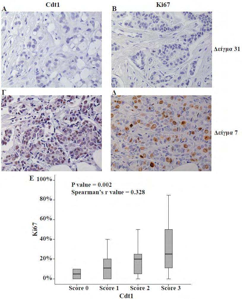 4. Αποτελέσματα Εικόνα 4.1.9: Η υπερέκφραση του Cdt1 συσχετίζεται με την έκφραση του δείκτη κυτταρικού πολλαπλασιασμού Ki67 σε δείγματα καρκίνου μαστού.