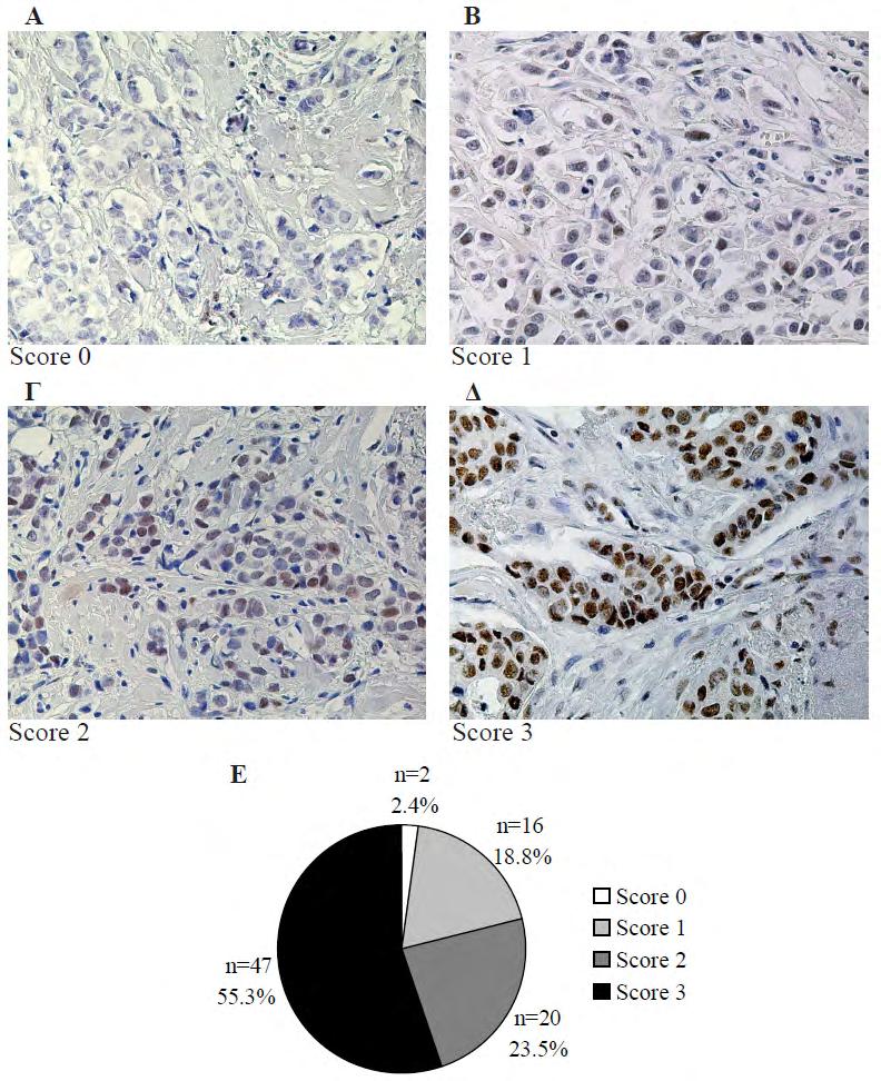4. Αποτελέσματα Εικόνα 4.1.3: Ετερογένεια στην ανοσοϊστοχημική χρώση του Cdt1 μεταξύ των διαφορετικών δειγμάτων καρκίνου μαστού.