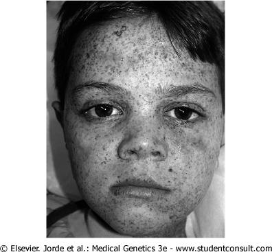 Εκόνα 3.8. Μελαχρωματική ξηροδερμία [Xeroderma pigmentosum (XP)]. Το δέρμα αυτού του ασθενή έχει πολλαπλά υπερκεχρωσμένα τραύματα, και δύο όγκους δέρματος στο μέτωπο που έχουν μαρκαριστεί για αποκοπή.