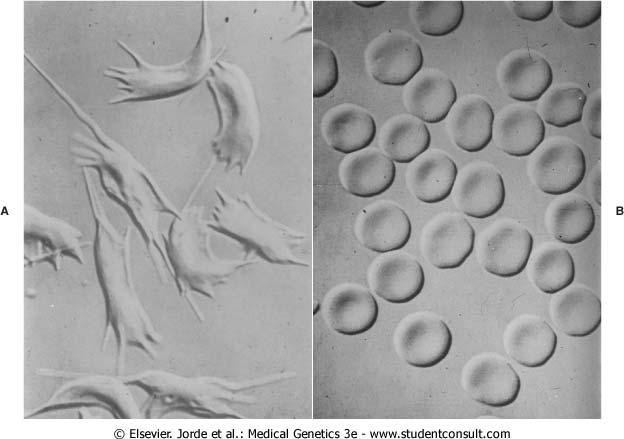 Εικόνα 3.5. Τα ερυθροκύτταρα των ασθενών με δρεπανοκυτταρική ασθένεια αποκτούν ένα χαρακτηριστικό σχήμα κάτω από συνθήκες χαμηλής τάσης οξυγόνου (A), Σύγκριση με κανονικά ερυθροκύτταρα (B).