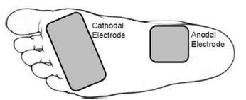 Voiding Dysfunction Transcutaneous Electrical Nerve Stimulation of the Foot: Results of a Novel At-home, Noninvasive Treatment for Nocturnal Enuresis in Children Matthew C. Ferroni et al.