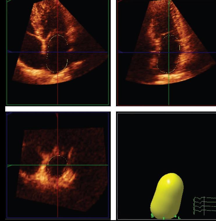 3D Echocardiography Η εκτίμηση των όγκων του αριστερού κόλπου με την 3D ηχωκαρδιογραφία είναι ακριβής και