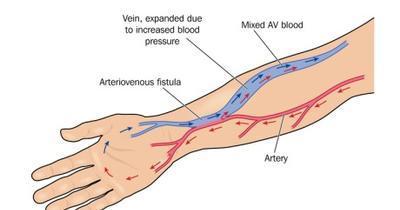 Αγγειακή προσπέλαση Αρτηριοφλεβική αναστόμωση (Fistula) / Μόσχευμα (graft) Καλύτερη λειτουργικότητα