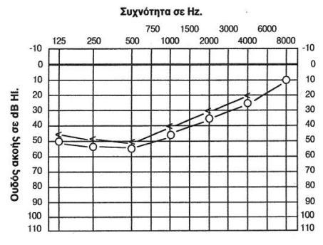Διαπιστώνεται νευροαισθητήρια βαρηκοΐα στις χαμηλές κυρίως συχνότητες (πχ.