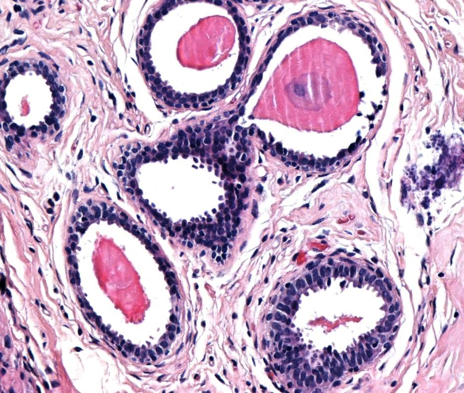 Εικ. 13. Αλλοιώσεις των κυλινδρικών κυττάρων με ενδοαυλικές μικροασβεστώσεις.