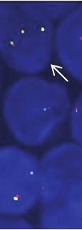 Kinase) Dual Color, Break Apart Rearrangement Probe.