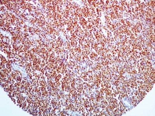 στα δύο αντι- Cyclin D1 McAbs (Α: SP4 κλώνος Β: κλώνος DCS-6).