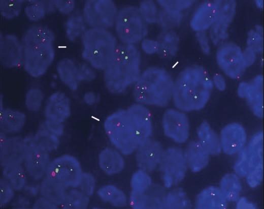 Εικόνα 19. FISH με τους LSI Cyclin D1 (11q13) / CEP11 ιχνηθέτες.