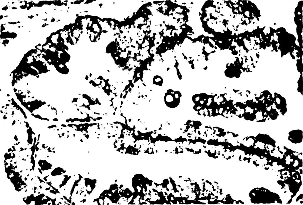 ΠΑΡΑΡΤΗΜΑ A Εικόνα 11: Ανοσοϊστοχημική έκφραση της καθεψίνης-d σε όγκο της ωοθήκης οριακής κακοήθειας