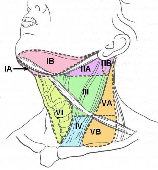 Σχήμα Ι. Επίπεδα και υποεπίπεδα τραχήλου. Η έκταση του λεμφαδενικού καθαρισμού των υπεργλωττιδικών καρκινωμάτων αποτελεί πεδίο αντιπαραθέσεων για πολλά χρόνια.