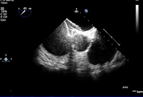 LONG-TERM FOLLOW-UP OF ASD CLOSURE WITH THE AMPLATZER REPORTED LATE COMPLICATIONS Atrial-aortic wall erosions Device position with lower