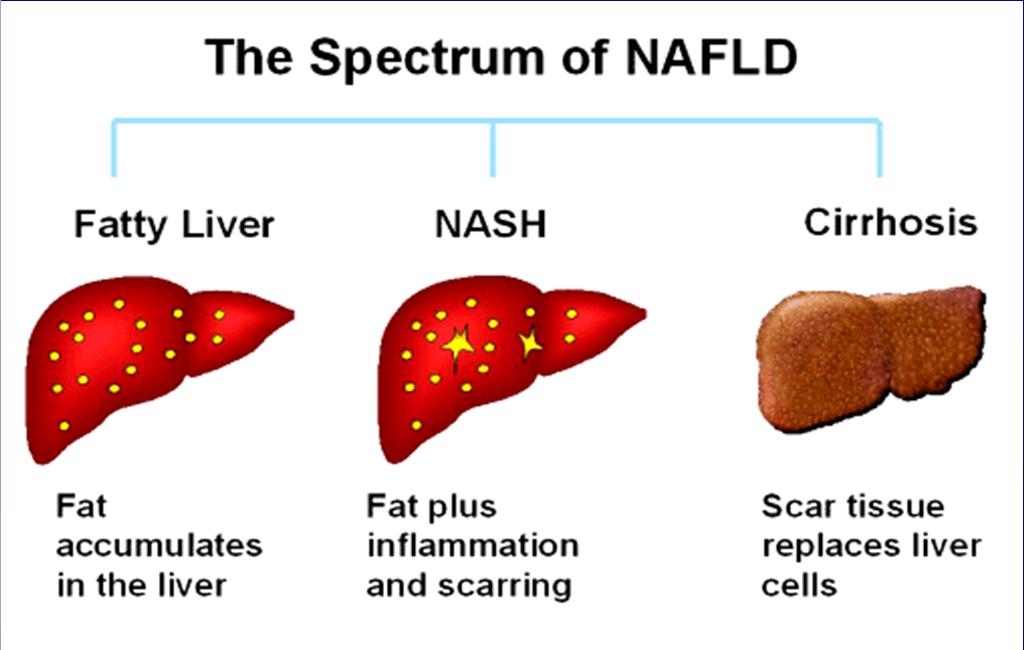 Non-Alcoholic Liver Disease model for the study of the secondary complications of obesity Fibrosis