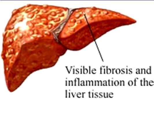 Kay, ACG website NAFLD affects up to 35 % of adults and nearly 5 % of children.