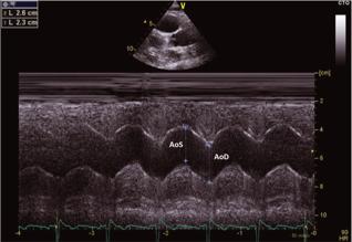 M-mode διαστάσεις αορτής (3 cm πάνω από ΑοΒ (AoD διάµετρος στο χρόνο του QRS, και AoS διάµετρος στη
