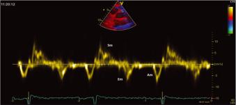 Ιστικό Doppler στην ανιούσα Αο µε µέτρηση τοιχωµατικών τα χυτήτων σε συστολή (Sm), πρώιµη διαστολή (Em),