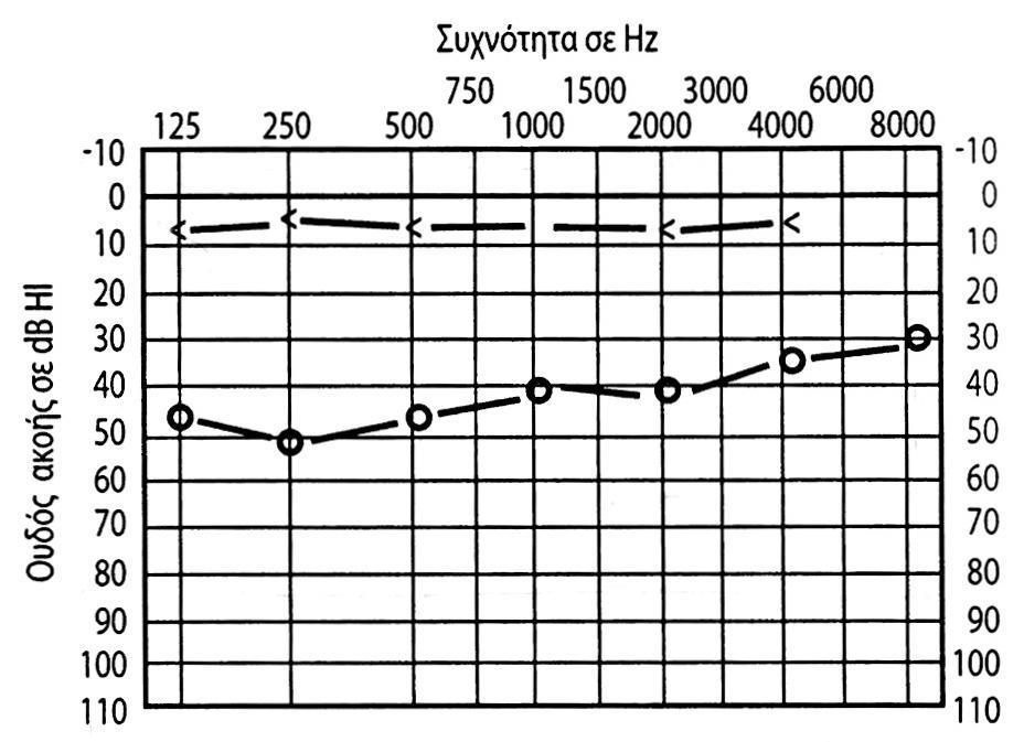 Είδη βαρηκοΐας Βαρηκοΐα αγωγιμότητας στο δεξί αυτί * 8 Ακουστική απώλεια τύπου αντιλήψεως-νευροαισθητήρια Προκαλείται από ελαττώματα στο έσω αυτί ή στο ακουστικό νεύρο, το οποίο μεταφέρει τα