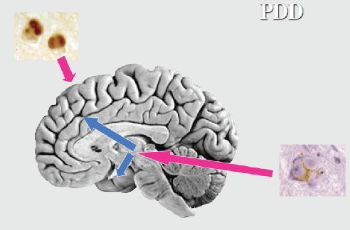 Άνοια νόσου του Parkinson & Άνοια με σωμάτια του Lewy (Παρκινσονισμός + Άνοια) Διακυμάνσεις στη νοητική