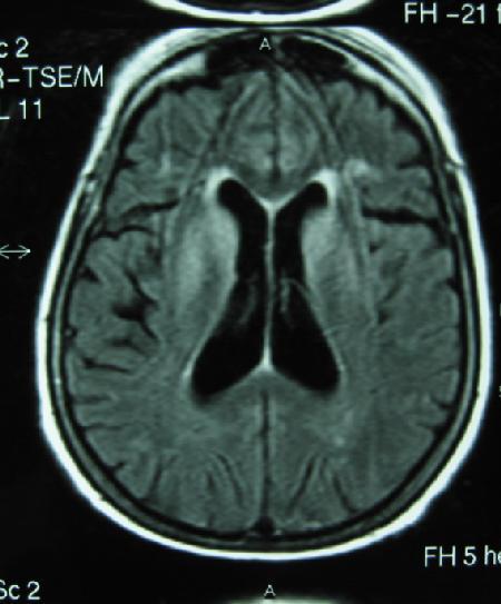 Σπογγώδης Εγκεφαλοπάθεια (CJD)