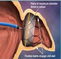 Event-free probability 1.0 Intent-to-Treat All Stroke Device Control Posterior probabilities Events Total Rate Events Total Rate RR Non- Superiority Cohort eve pt-yr (95% CI) (no.