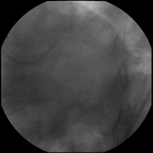 Αποτυχία εμφφτευςθσ stent-des 3.