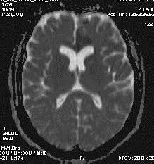 Non-Contrast CT and conventional MRI in detecting