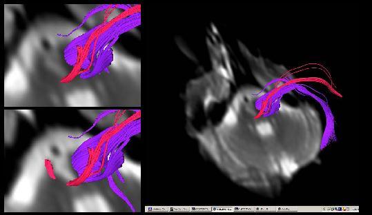 TRACTOGRAPHY ΣΕ ΙΣΧΑΙΜΙΑ Οξύ έμφρακτο: περιορισμένη εφαρμογή-εντοπισμός οξέων εμφράκτων