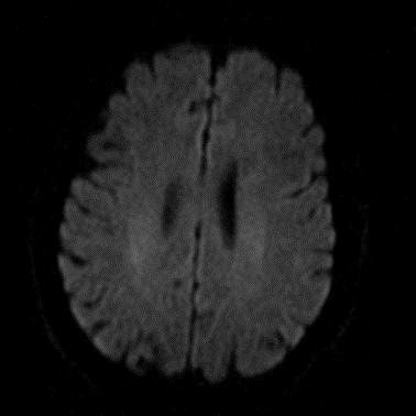 ΤΕΧΝΙΚΗ ΜΟΡΙΑΚΗΣ ΔΙΑΧΥΣΗΣ ΣΤΗΝ ΣΚΠ 40 yrs, male, RRMS, EDSS=2.