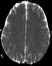 Papadaki et al ECR 2005 ΣΚΠ: ΔΙΑΧΥΤΗ ΝΟΣΟΣ ΤΗΣ ΛΕΥΚΗΣ