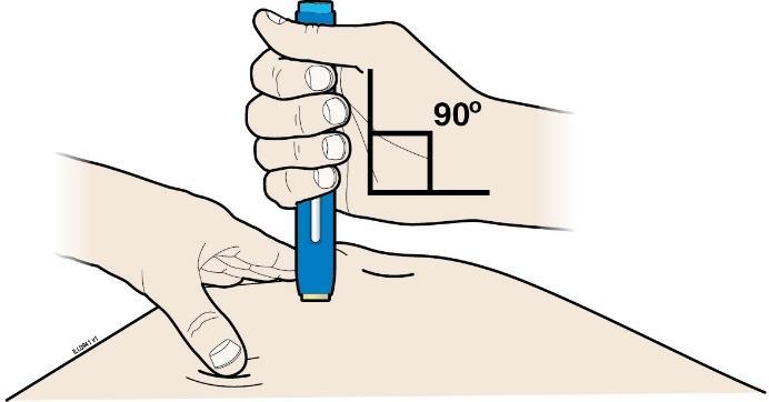Step 3: Inndæling G. Haldið áfram að teygja á eða klípa í húðina.