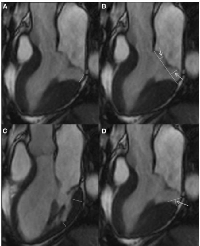 MITRAL ANNULUS DISJUNCTION (MAD) IN LGE MVP