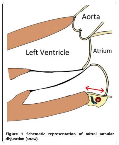 finding in myxomatous mitral valve disease patients,