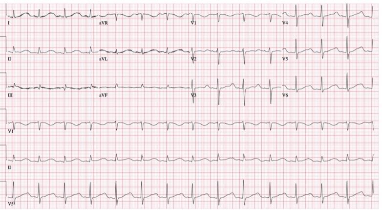 Sudden Cardiac Death, Mitral Valve Prolapse, and Long QT Syndrome The American Journal of Medicine, Vol 128, No 10,