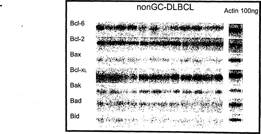 πρωτεϊνών σε περιπτώσεις GCB-DLBCL και