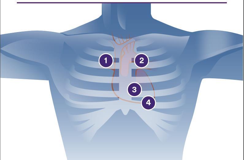 Ο δεύτερος θόρυβος της καρδιάς, ή το S2, εμφανίζεται στο τέλος της κοιλιακής συστολής, τη στιγμή της διακρωτικής εγκοπής στην καμπύλη κοιλιακής πίεσης.