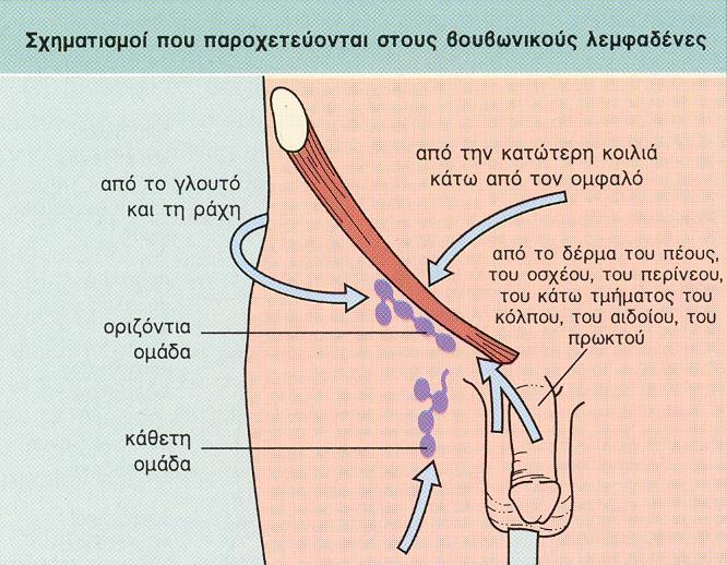 Αντικειμενική εξέταση βουβωνική λεμφαδενοπάθεια Συχνά μη ειδική ΛΠ, τραυματισμοί και μικροφλεγμονές κάτω