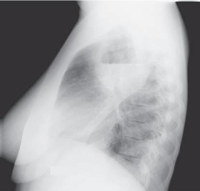 Absces pulmonar Empiem pleural apare la aprox. 5% din bolnavii netratati si la aprox. 1% din cei tratati.