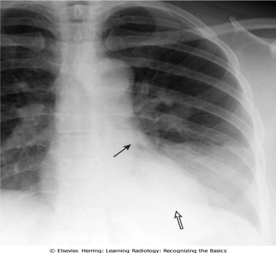 cu Legionella. Un studiu asupra rezolutiei radiologice a artat o rezolutie completa in 4 saptamina pentru 67%cazuri, in 6 saptamini pentru 73% cazuri, in 8 saptamini in 85%cazuri.