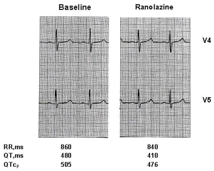 Effect of Ranolazine on QTc interval in LQT3 Moss
