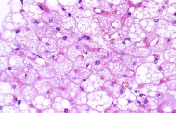 Εικόνα 16. Φωτογραφία καστανού λιπώδους ιστού από φωτονικό μικροσκόπιο (PathologyOutlines.com). 2.