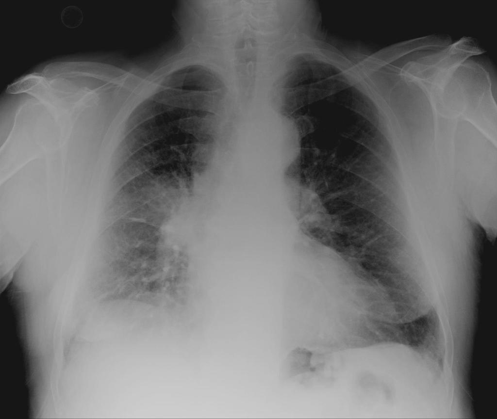 Διόγκωση της δεξιάς πνευμονικής πύλης με ασαφή