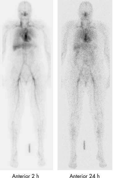 πινκθρογράφθμα με Tc99m-Infliximab (10mg-740MBq) εγχφκθκε μαηί με τθ δόςθ 3mg/kg: Tc99m-Infliximab Ανηαποκπιθείρ Μεγαλφτερθ πρόςλθψθ από ιπαρ & ςπλινα ςτισ 2 ϊρεσ ςτον μθ ανταποκρικζντα